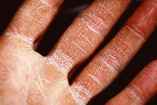 Which Natural Handmade Soap Is Best For Dry Skin?